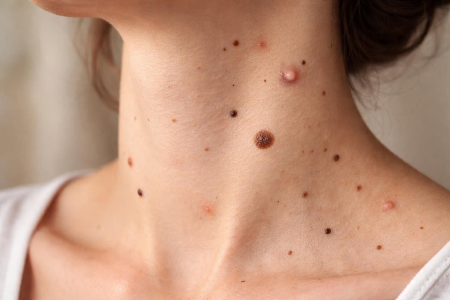 découvrez comment identifier et différencier les taches brunes ou noires dans le cou des autres imperfections cutanées, pour mieux comprendre leur origine et choisir les soins adaptés.